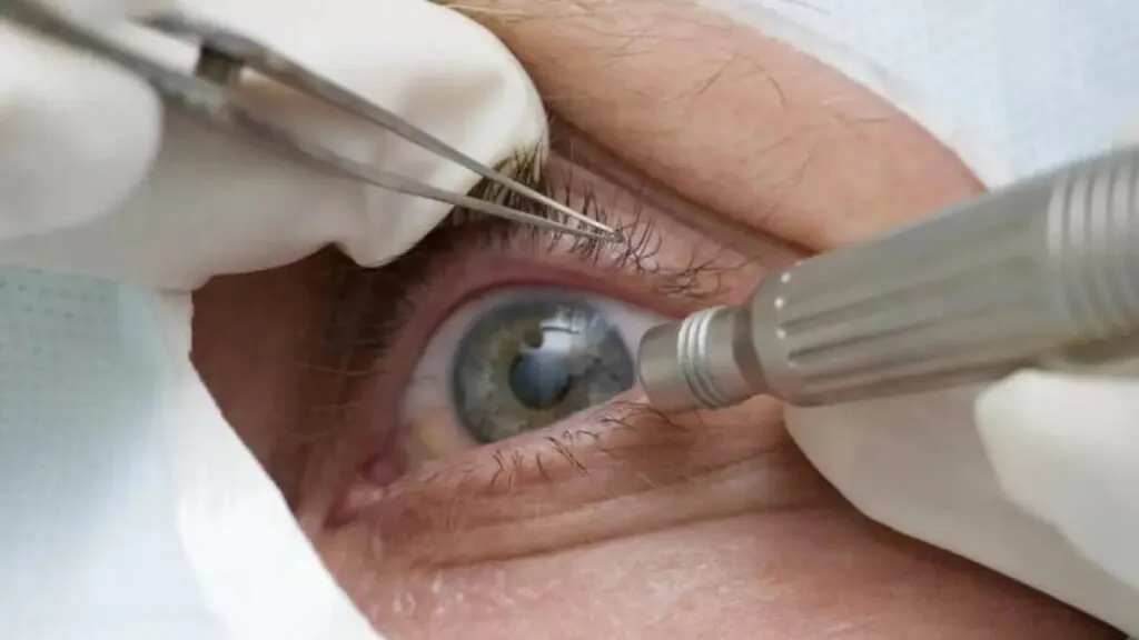 quais-os-riscos-da-cirurgia-que-altera-cor-dos-olhos-pacientes-relatam-dificuldade-de-enxergar-dor-nos-olhos-ardenciadentre-outros-efeitos-foto-pmtb-divulgacao-tvt-news