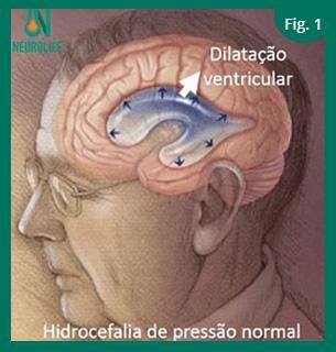 Hidrocefalia normobárica: entenda condição e a cirurgia de Chico Buarque 1 hidrocefalia-normobarica-de-pressao-normal-reproducao-neurolife-tvt-news