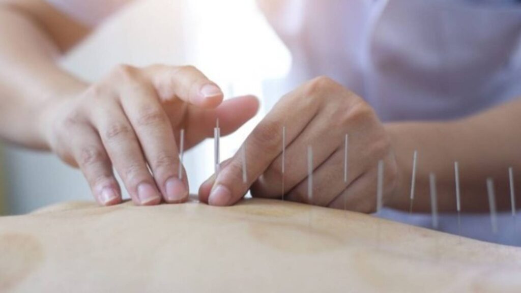 exercicio-profissional-de-acupuntura-e-regulamentado-no-brasil-lei-assegura-o-exercicio-profissional-a-pessoas-com-formacao-superior-em-acupuntura-foto-divulgacao-tvt-news