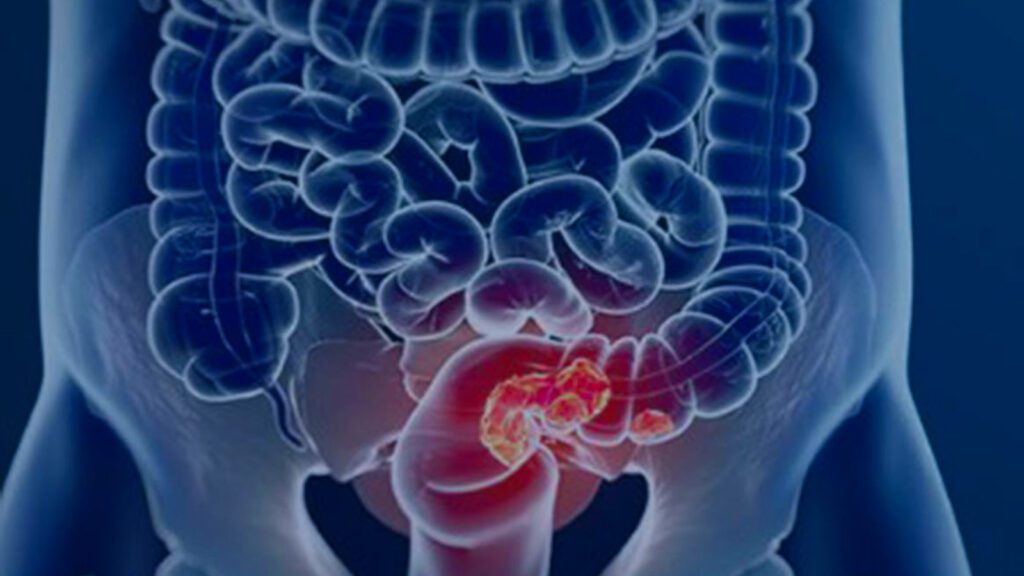 SUS-adota-novo-exame-para-detectar-cancer-de-intestino-camara-municipal-afonso-claudio-divulgacao-tvt-news