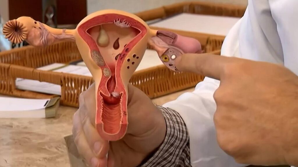 aberta-chamada-publica-para-pesquisas-sobre-endometriose-colicas-fortes-principal-sintoma-da-endometriose-podem-levar-mulheres-a-perder-ate-10-8-horas-de-trabalho-por-semana-foto-frame-tv-brasil-tvt-news